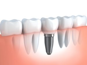Image showing how dental implants work when placed by a certified dental implant expert.