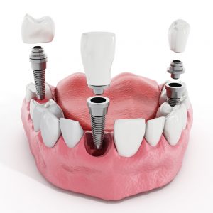 display of dental implants