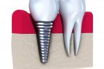 dental implants provide good solution for tooth loss
