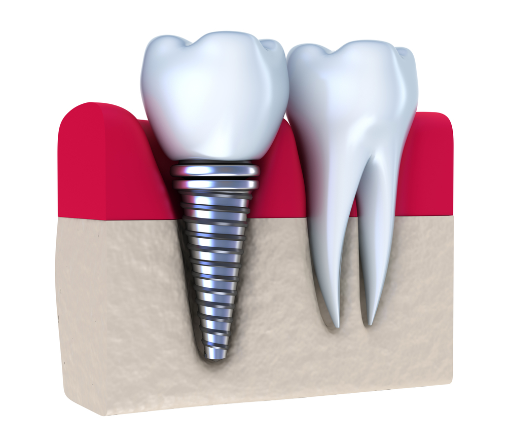 dental implants provide good solution for tooth loss